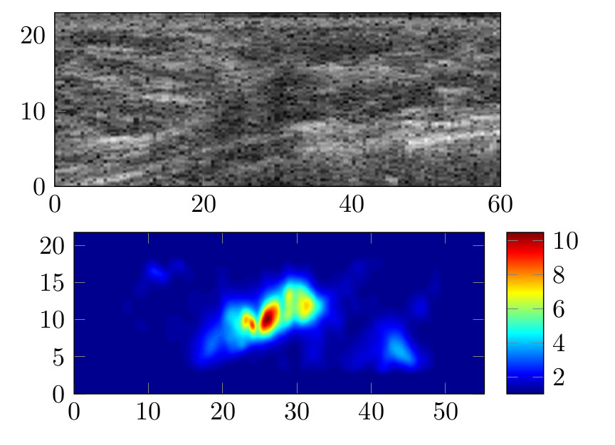 Ultrasound and elastography images of an infiltrating ductal carcinoma